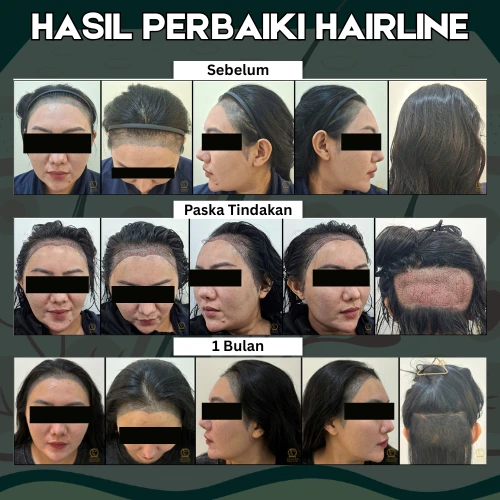 Before After Tanam Rambut Glojas - Kasus 1