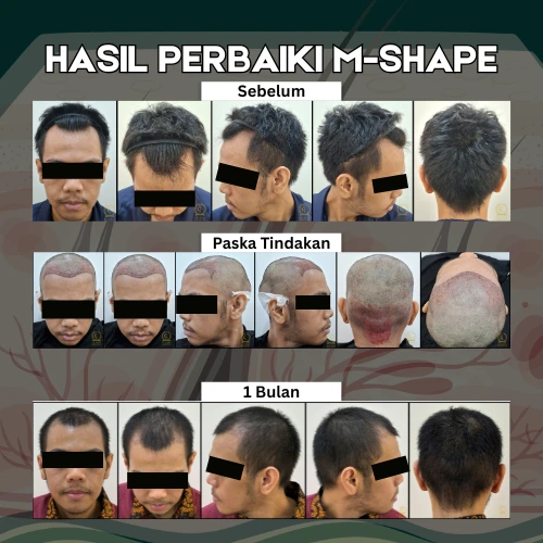 Before After Tanam Rambut Glojas - Kasus 2
