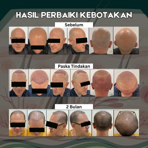 Before After Tanam Rambut Glojas - Kasus 3