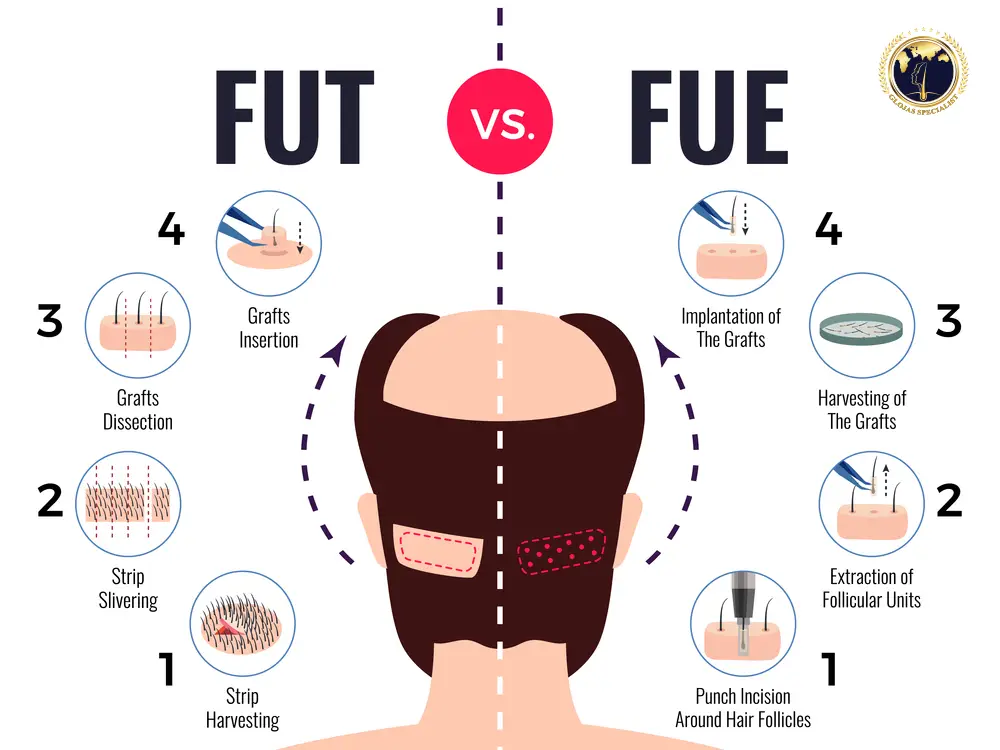 fue-fut-transplantasi-rambut-indonesia-methode