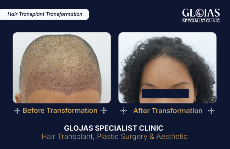 tanam-rambut-indonesia-fue-fut-transplantasi-rambut-jakarta