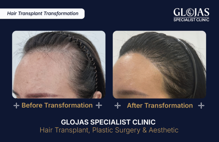 tanam-rambut-indonesia-fue-fut-transplantasi-rambut-jakarta