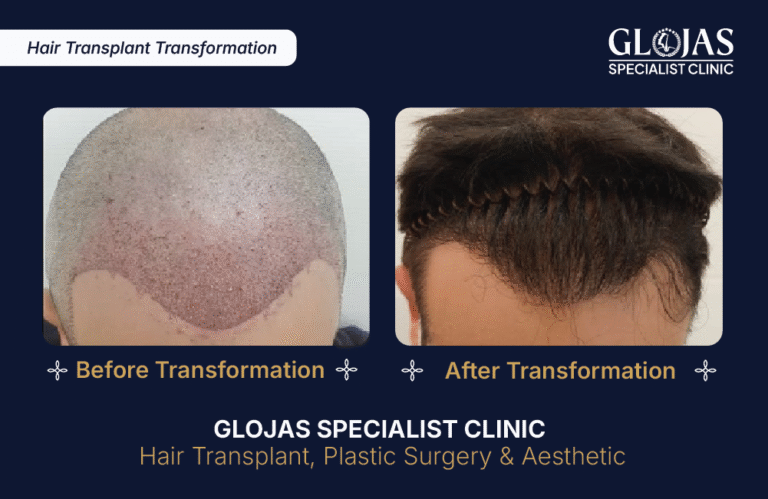 tanam-rambut-indonesia-fue-fut-transplantasi-rambut-jakarta
