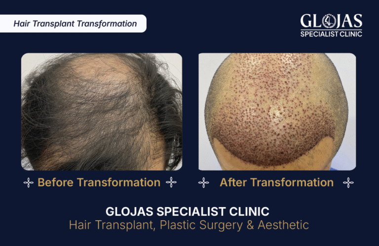 tanam-rambut-indonesia-fue-fut-transplantasi-rambut-jakarta