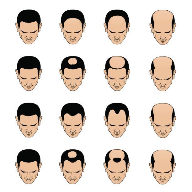 tanam-rambut-indonesia-kerontokan-rambut-male-pattern-baldness