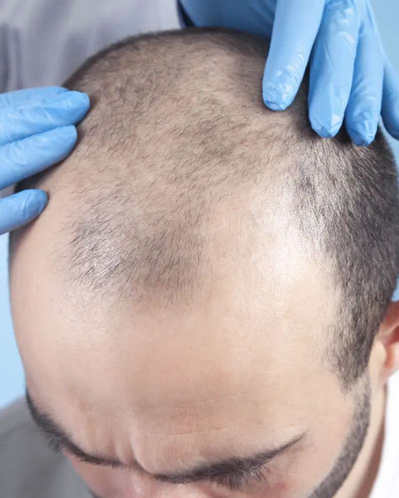 Hair Loss
