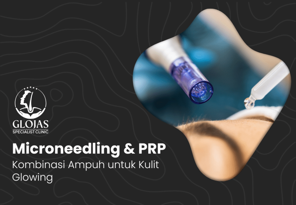 microneedling-prp