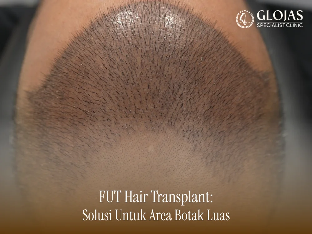 fut-hair-transplant-indo