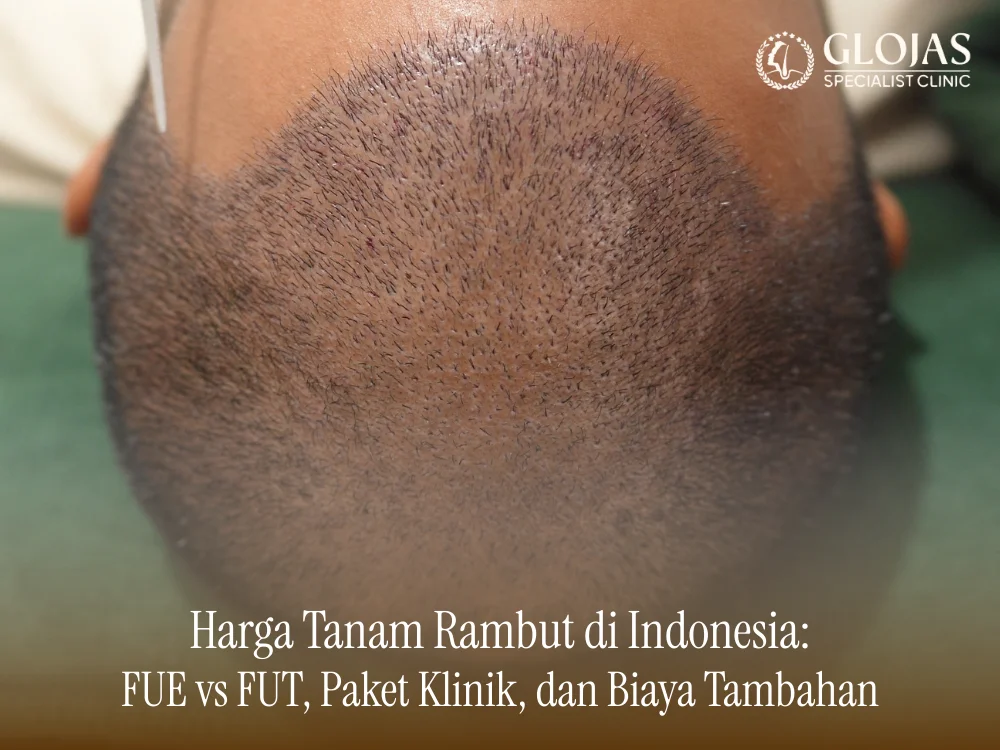 harga-tanam-rambut