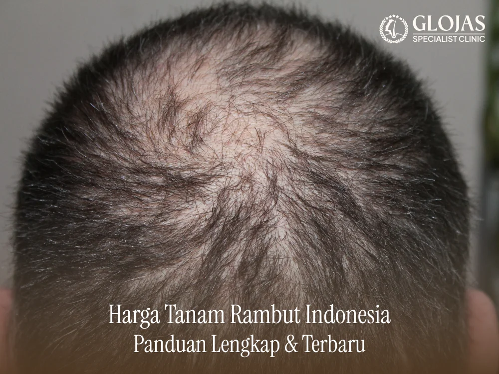 harga-tanam-rambut-indonesia