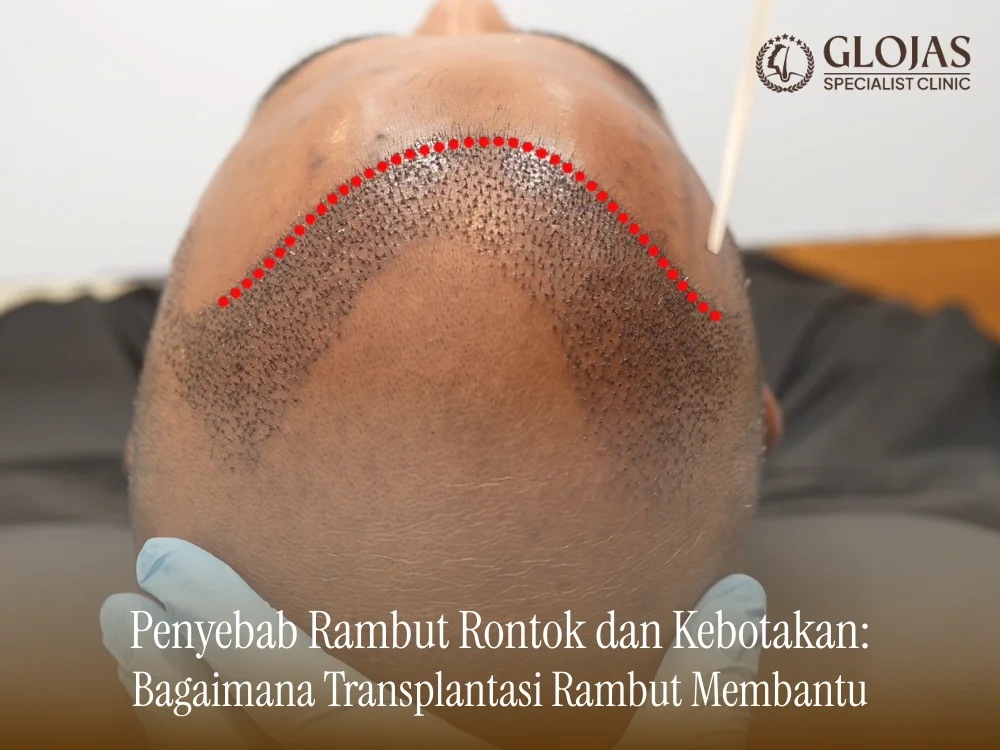 penyebab-rambut-rontok