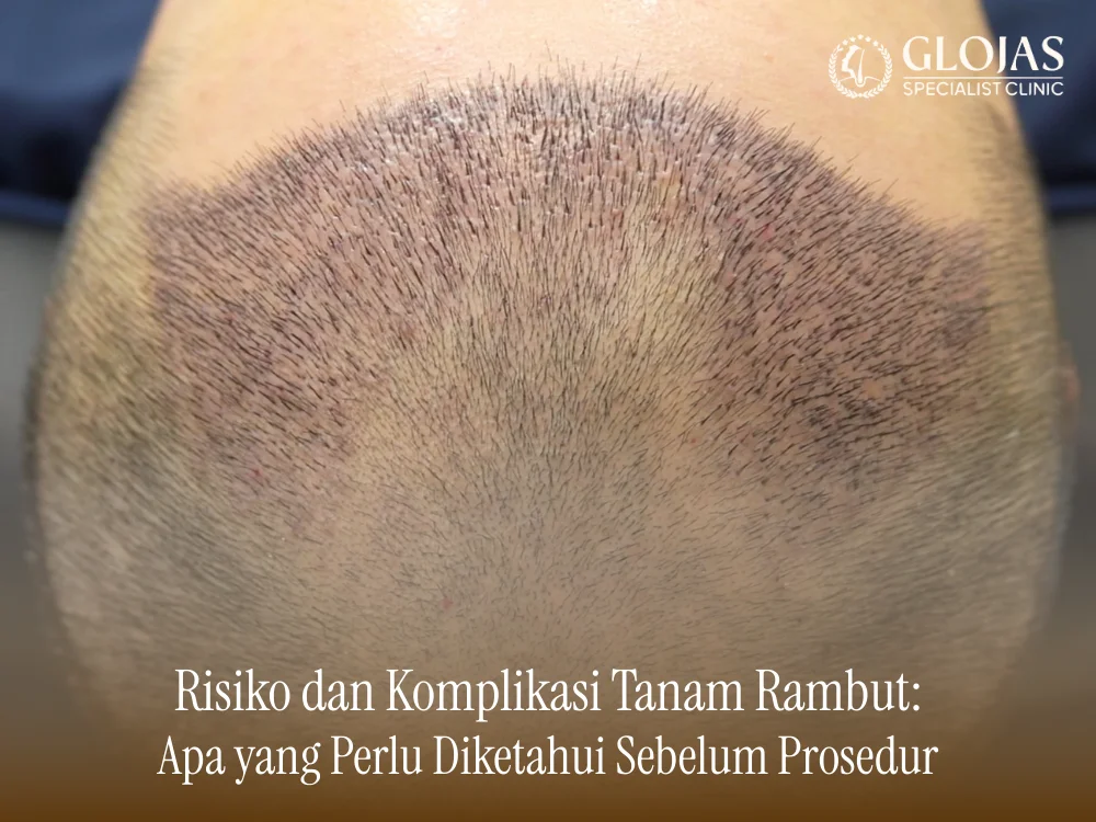 risiko-dan-komplikasi-tanam-rambut