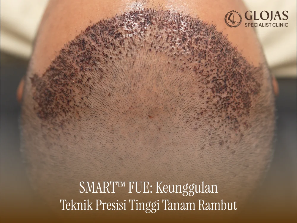 smart-fue-tanam-rambut