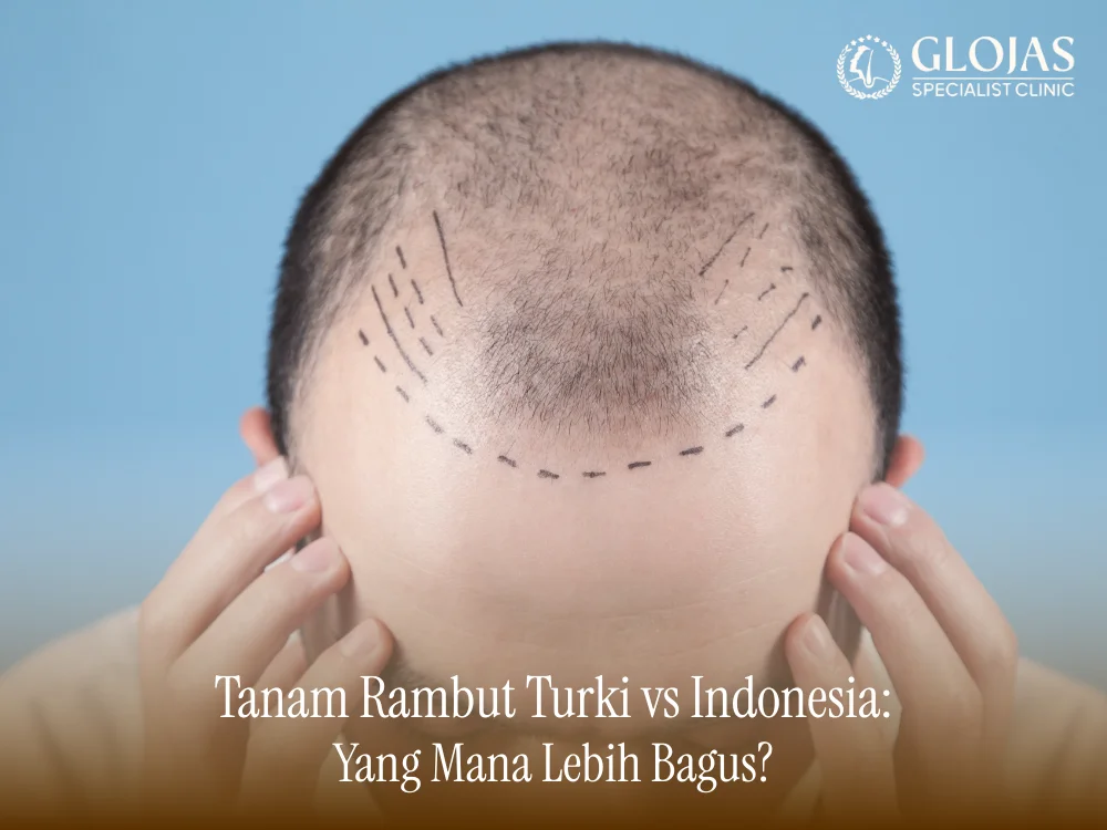 tanam-rambut-turki-vs-indonesia