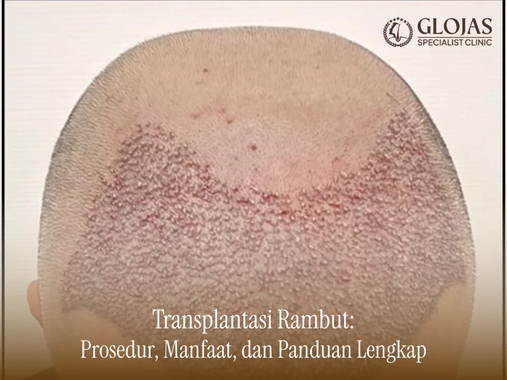transplantasi-rambut