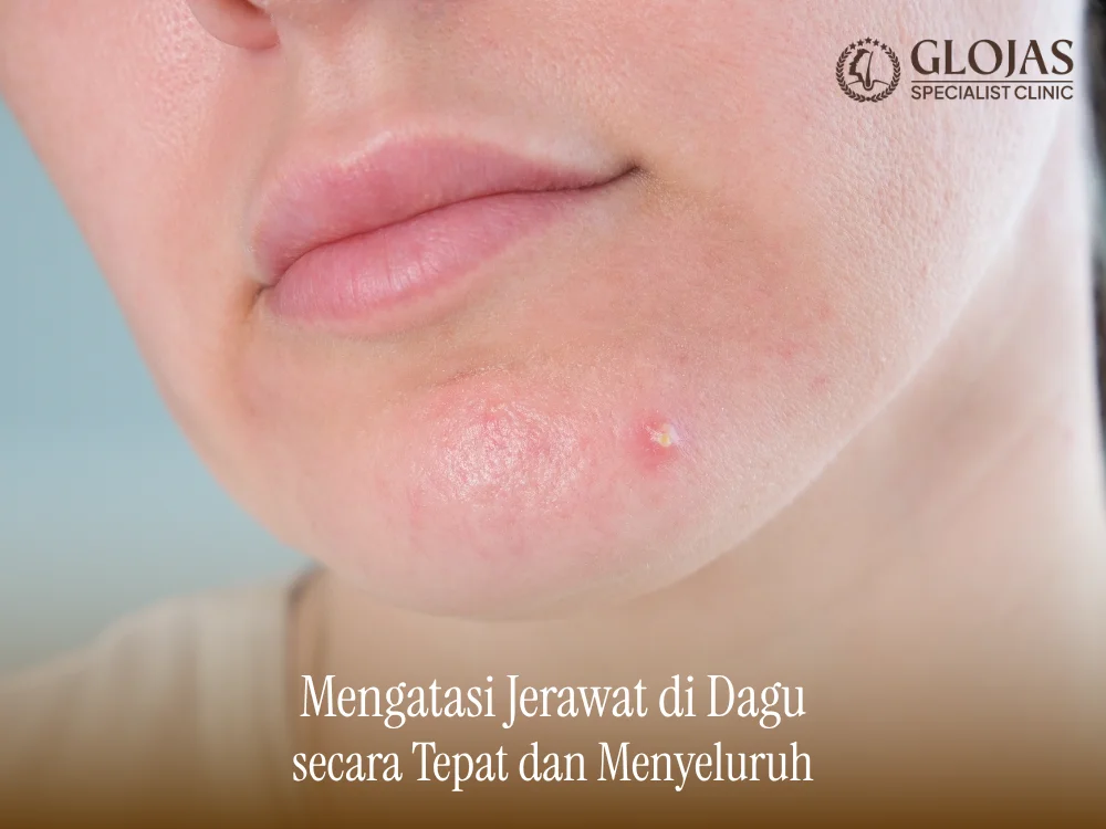 jerawat-di-dagu