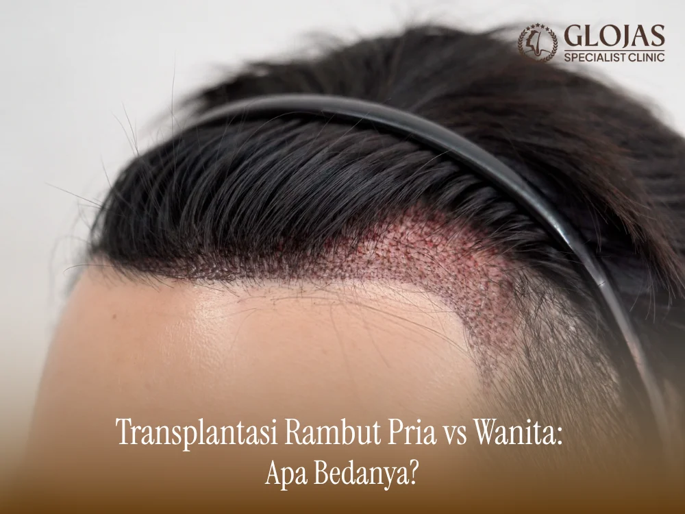 Transplantasi Rambut Pria vs Wanita: Apa Bedanya?