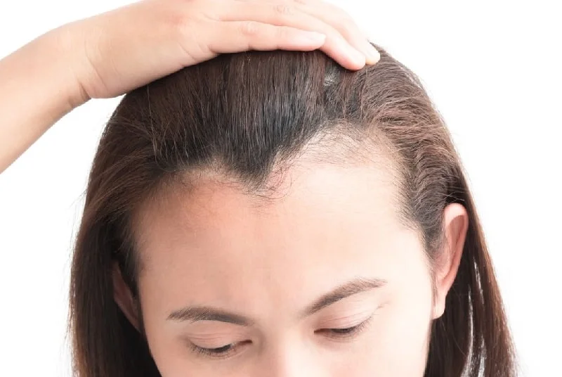 Hairline Lowering Pria dan Wanita