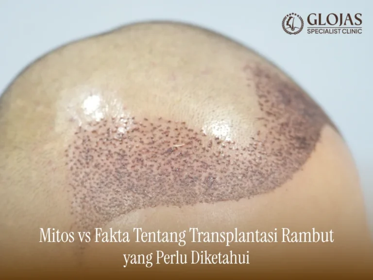 mitos-transplantasi-rambut