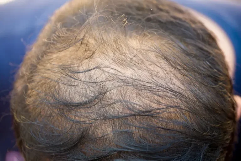 penyakit-kulit-kepala-rambut-gugur