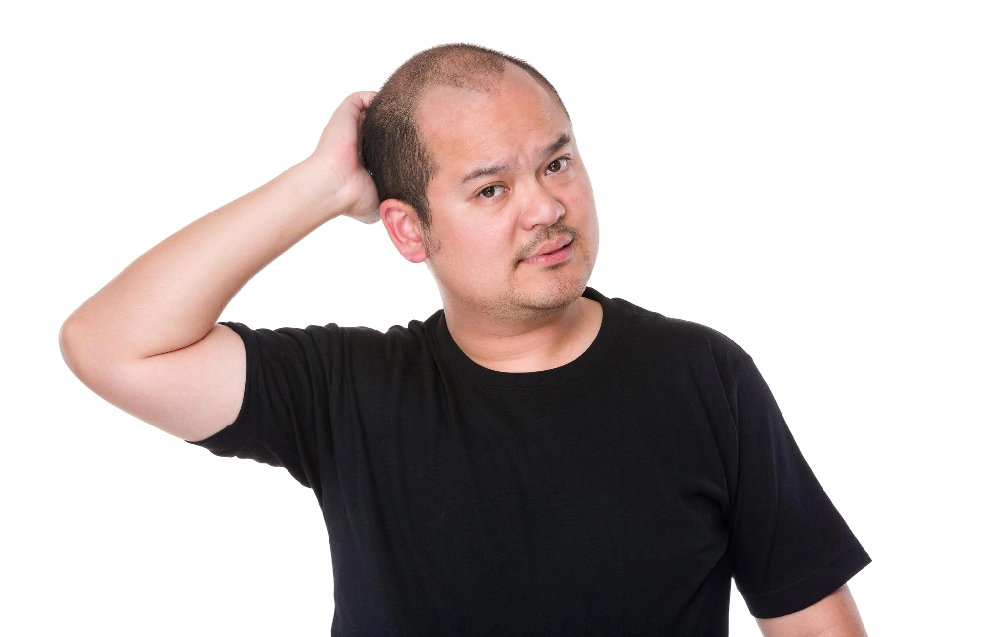 rambut-rontok-transplantasi-rambut-indonesia