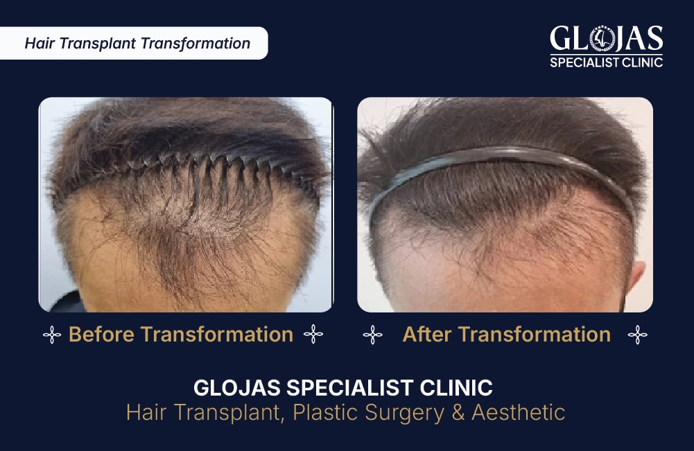 Hasil Tanam Rambut GLOJAS 2