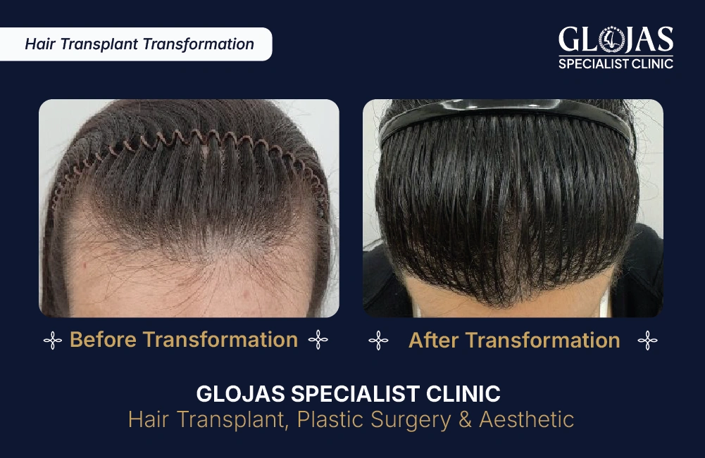 Hasil Tanam Rambut GLOJAS 9