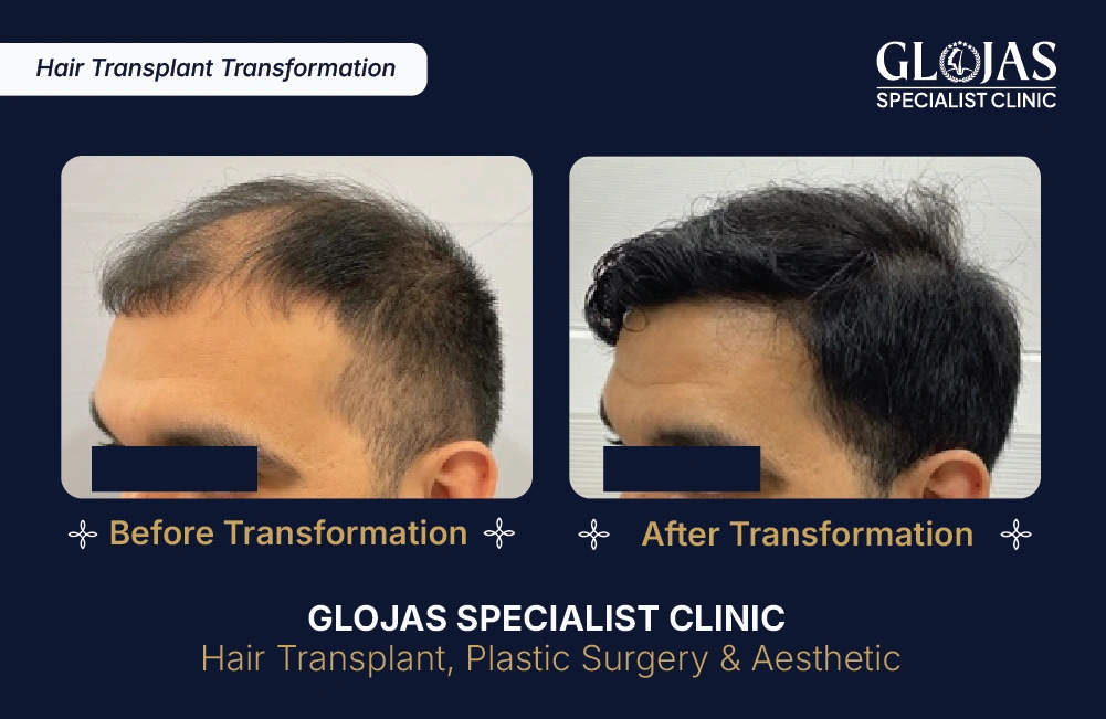 Hasil Tanam Rambut GLOJAS 8