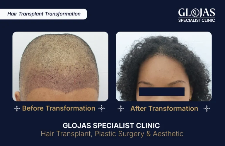transplantasi-rambut-indonesia-glojas-specialist-clinic (4)