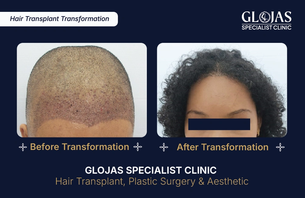 Hasil Tanam Rambut GLOJAS 7