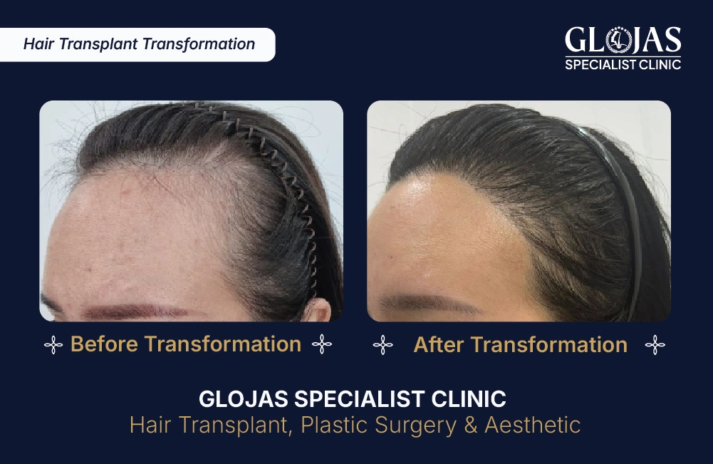 Hasil Tanam Rambut GLOJAS 6
