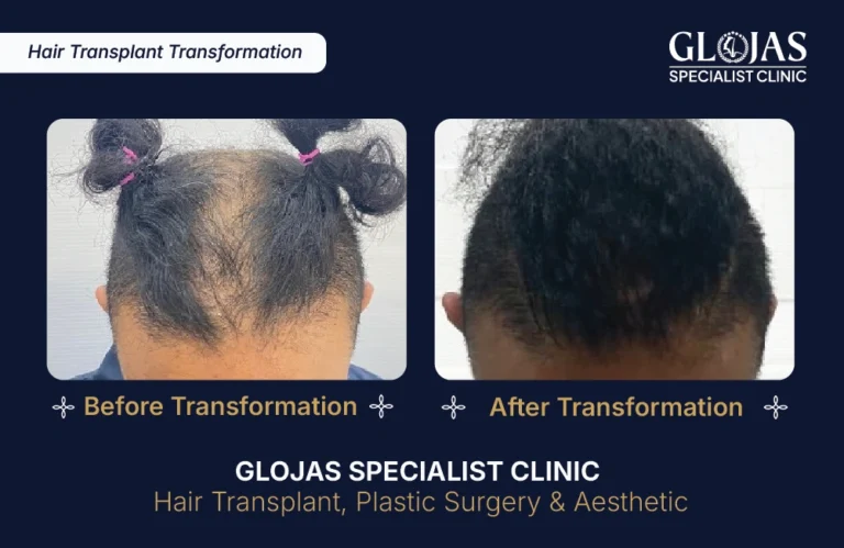 transplantasi-rambut-indonesia-glojas-specialist-clinic (6)