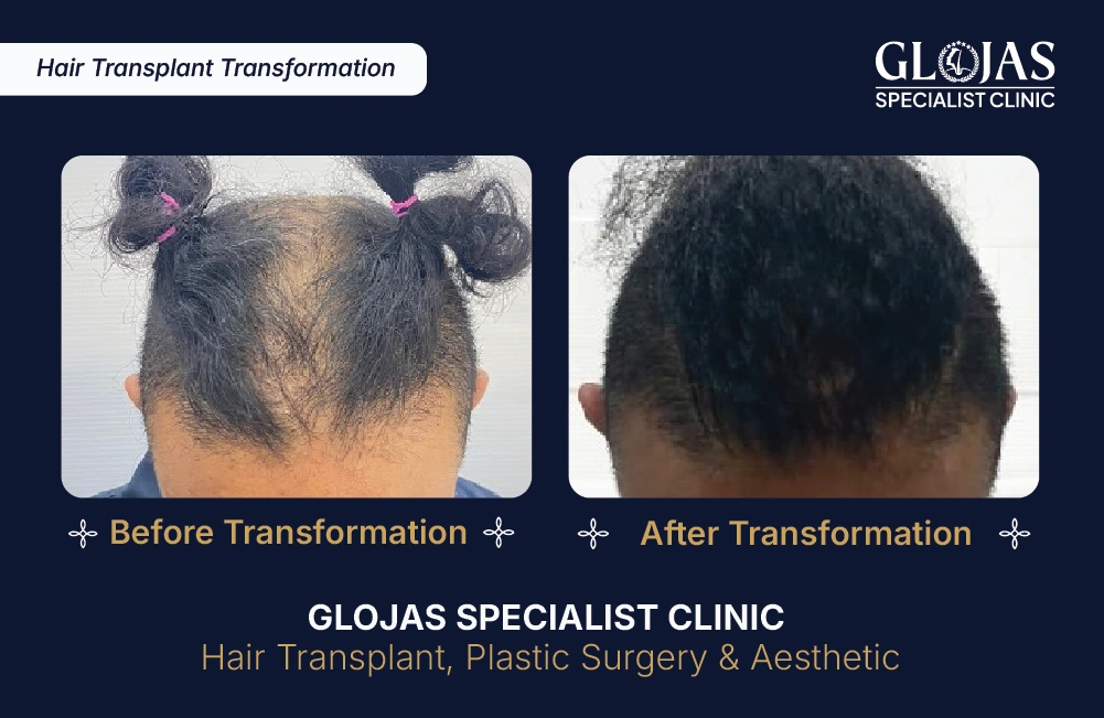 Hasil Tanam Rambut GLOJAS 5