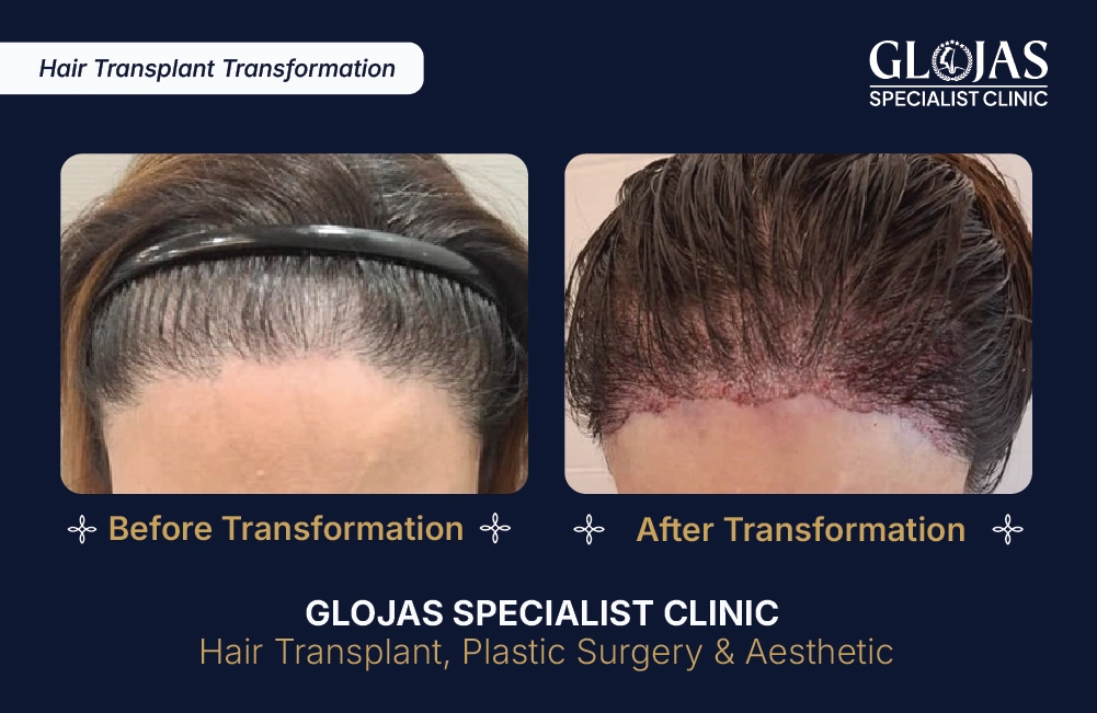 Hasil Tanam Rambut GLOJAS 3
