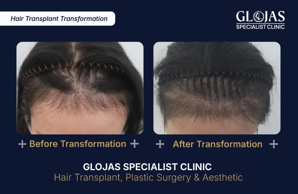 Hasil Tanam Rambut GLOJAS 1
