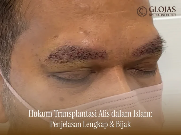 hukum-transplantasi-alis