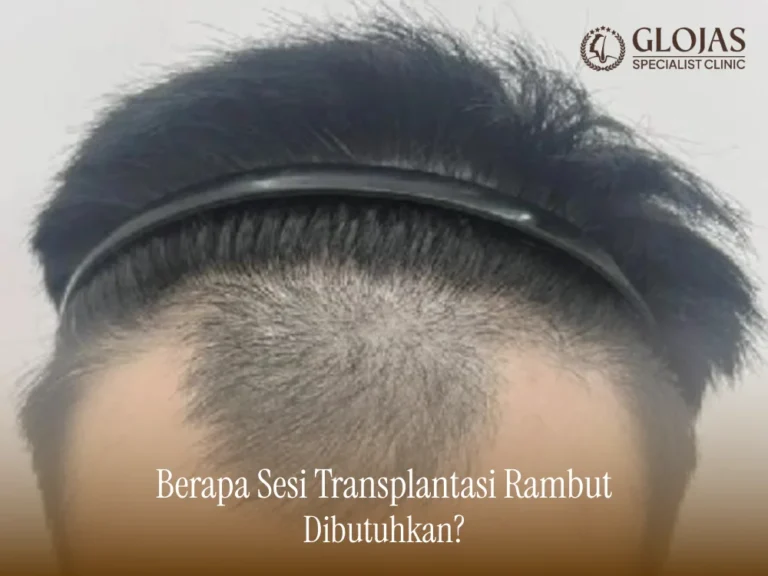 berapa-sesi-transplantasi-rambut