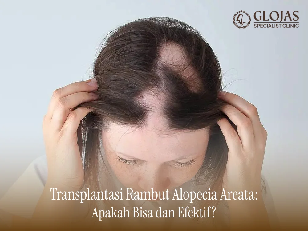 transplantasi-rambut-alopecia-areata