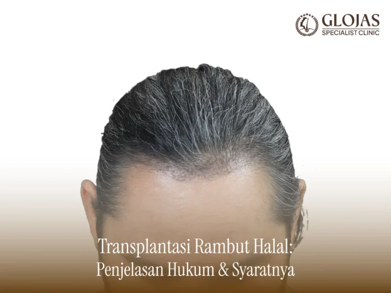 transplantasi-rambut-halal