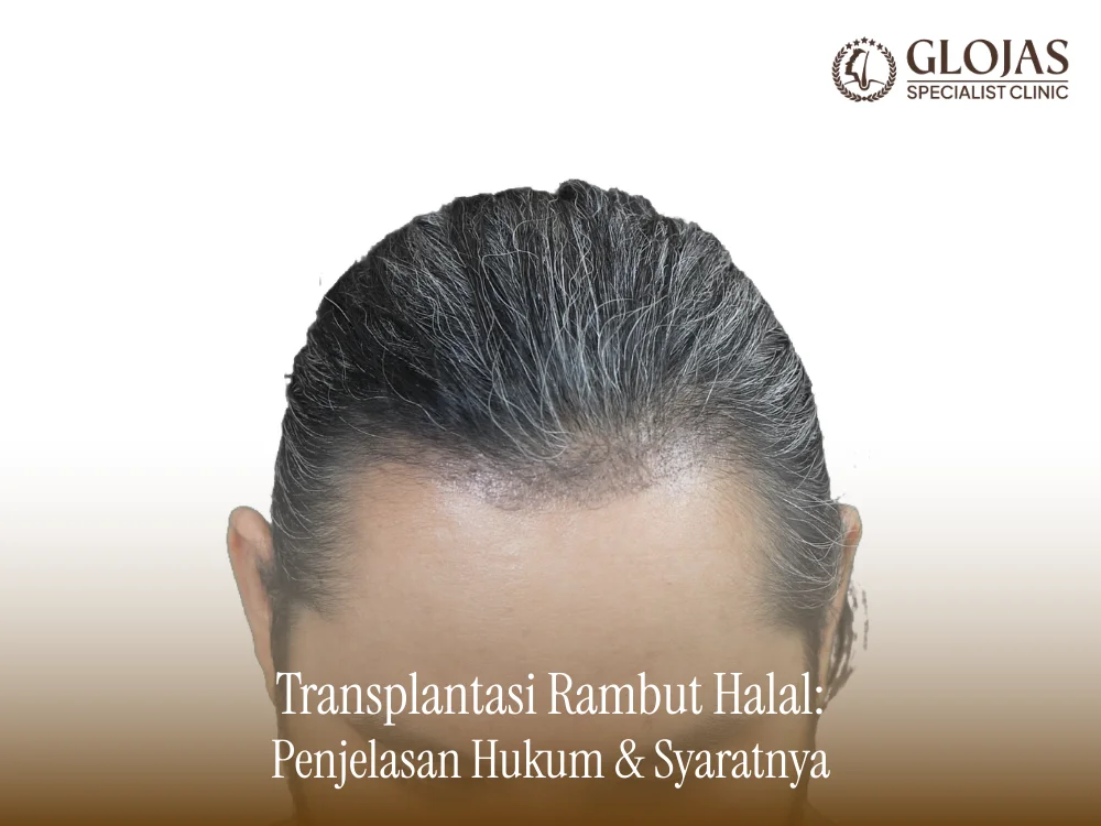 transplantasi-rambut-halal