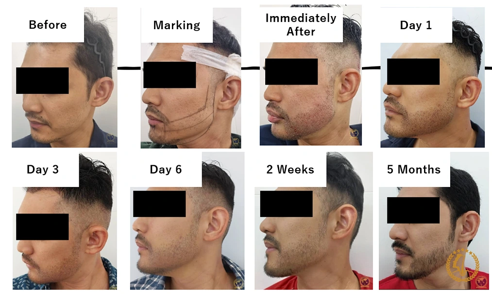 operasi tanam rambut