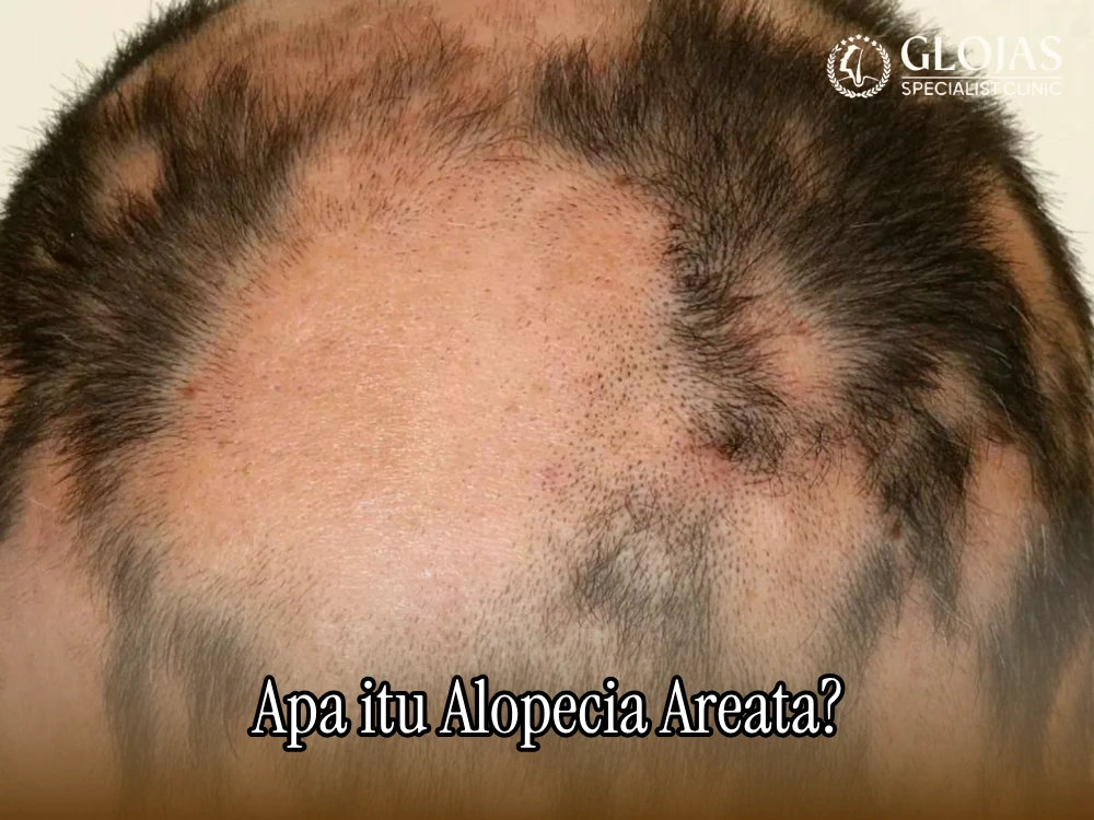 Alopecia Areata