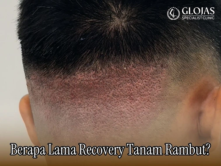 Berapa Lama Recovery Tanam Rambut?