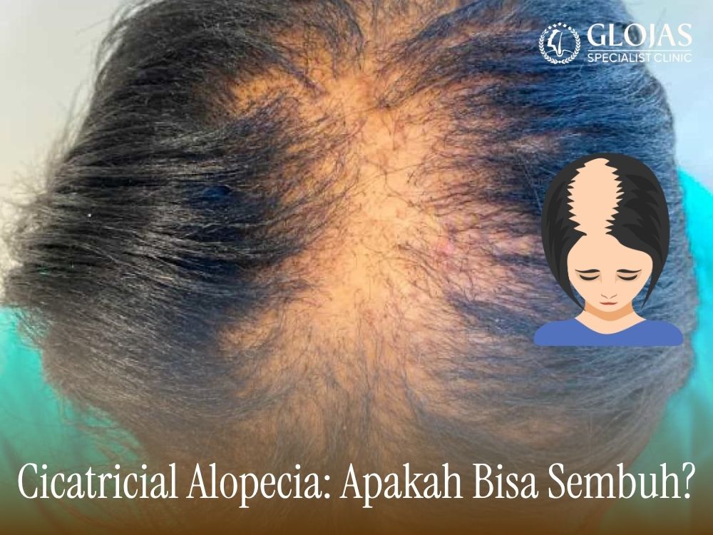 Cicatricial Alopecia