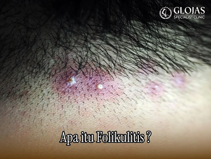 Folikulitis