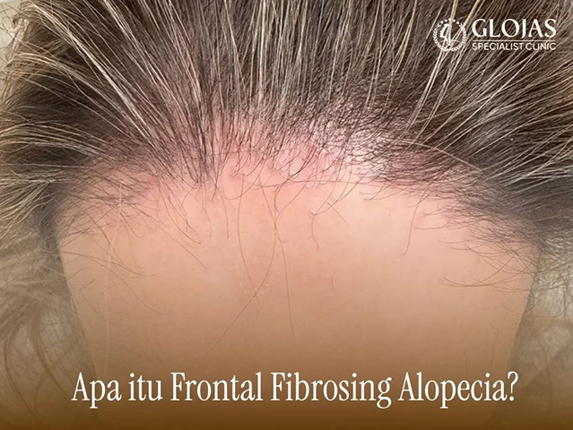 Frontal Fibrosing Alopecia