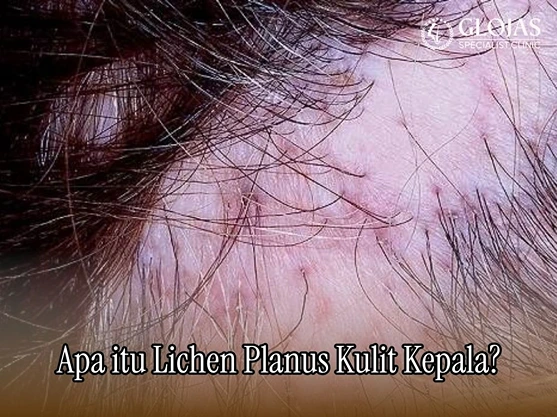 Lichen Planus