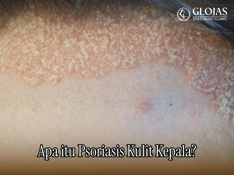 Psoriasis Kulit Kepala