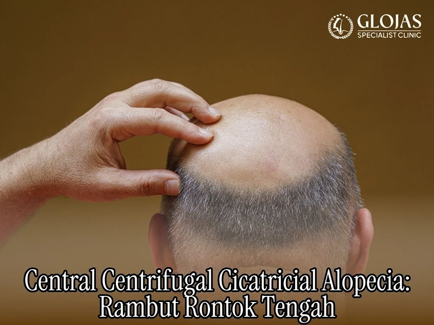 Central Centrifugal Cicatricial Alopecia