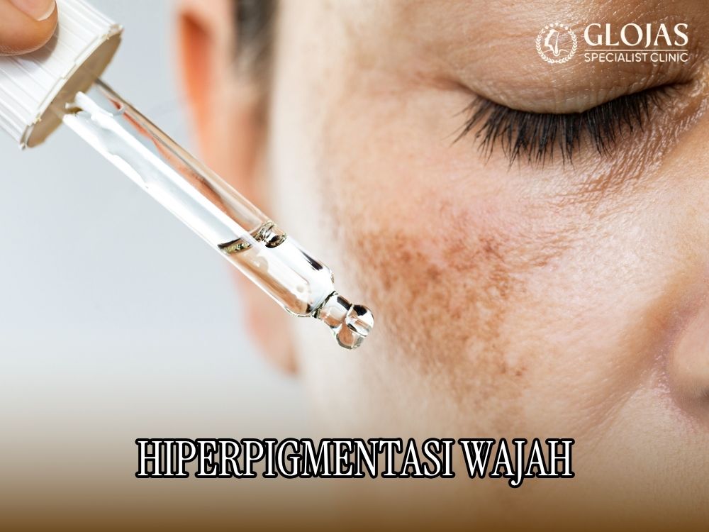 Hiperpigmentasi Wajah